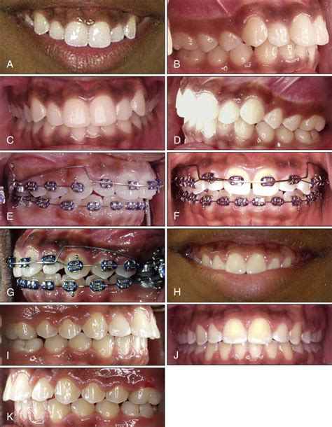 Etiology Diagnosis And Treatment Of Deep Overbite Pocket Dentistry