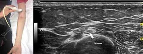 Frontiers Ultrasound In The Evaluation Of Radial Neuropathies At The
