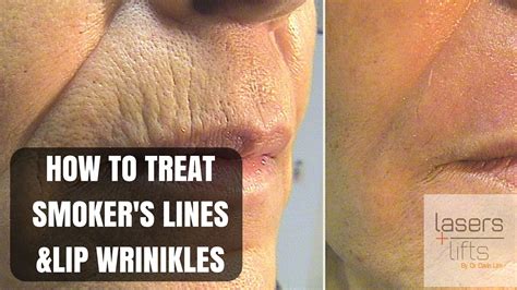 How To Treat Upper Lip Wrinkles And Smokers Lines Youtube