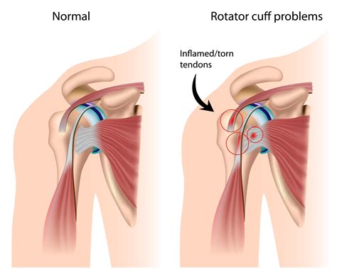 Questions Surrounding The Rotator Cuff Tear In Manny Pacquiaos