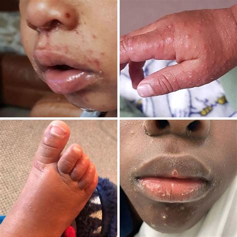 what is hand foot and mouth disease 2022