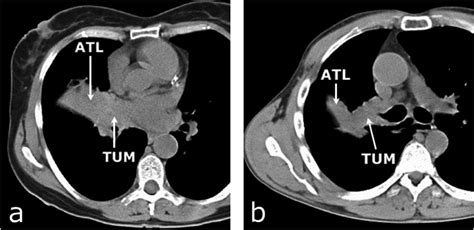 Example Slices Of Typical Lung Ct Images Of Two Patients With