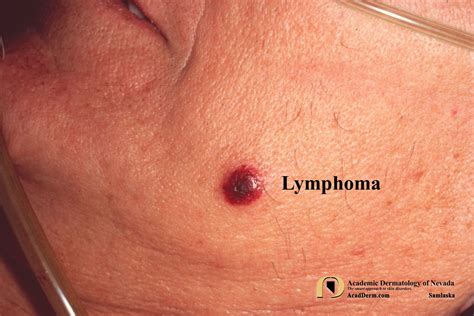 Cutaneous Lymphoma Please Contribute To The Leukemia Lymphoma Society Academic