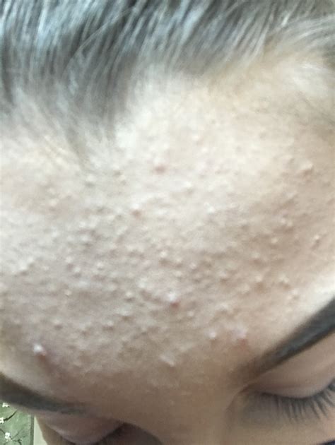 Tiny Bumps All Over Forehead General Acne Discussion Acne Org