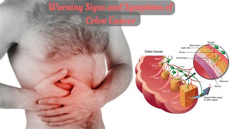 The sigmoid colon is the area of the intestine just above the rectum; Warning Signs and Symptoms of Colon Cancer