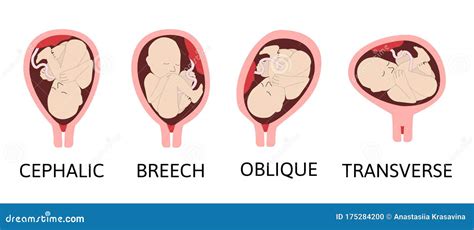 Oblique Baby Position In Pregnancy Babypregnancy