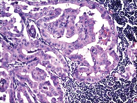 Axillary Lymph Node Metastasis In Papillary Thyroid Carcinoma Report
