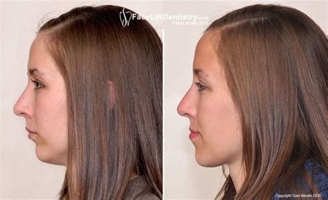 Overbite Correction And Jaw Realignment Without Surgery Hair Cuts