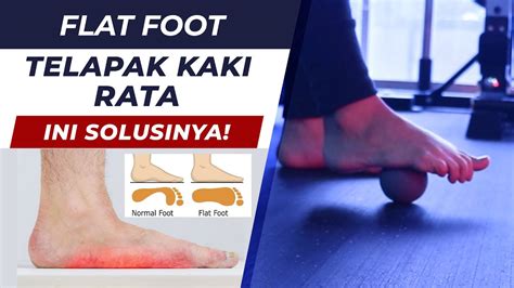 Solusi Latihan Untuk Telapak Kaki Rata Flat Foot Fisioterapi First