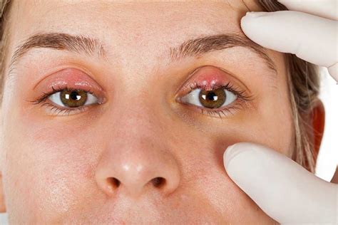 How Is Chalazion Treated Medivision