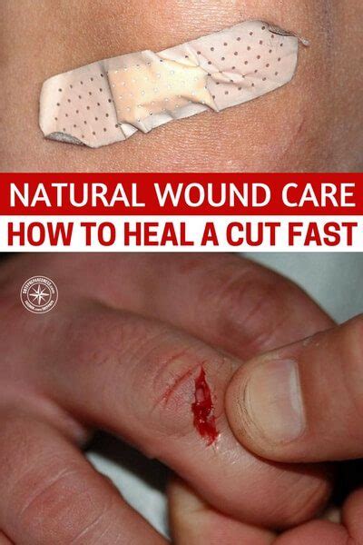 Natural Wound Care How To Heal A Cut Fast