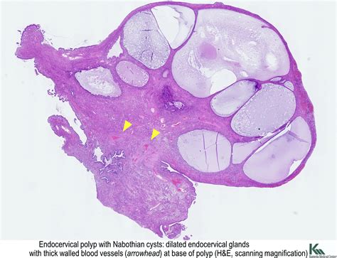 Pathology Outlines Nabothian Cysts