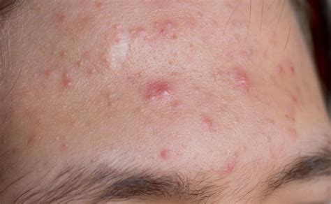 What Is Acne Rosacea With Pictures