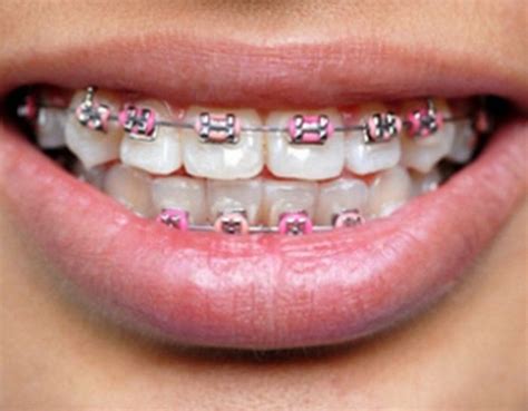 Light Red Braces Teeth Braces Ideas Braces Colors Pink Braces Cute Braces Colors