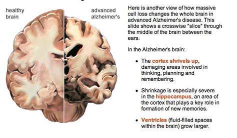 Normal Vs Alzheimers Brain Hemispheres Healthy Loss Alzheimers