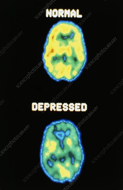 Depression 2 Axial Pet Scans Of The Brain Stock Image