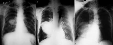 A Chest X Ray Pa View Showing An Opacity Approximately 3 × 3 Cm At