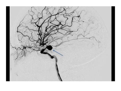 Posterior Communicating Artery Aneurysm In Year Old Female With Noonans Syndrome The