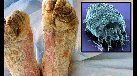 Scabies On Bottom Of Feet