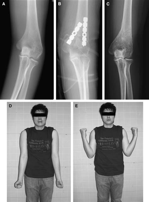 Corrective Dome Osteotomy For Cubitus Varus And Valgus In Adults