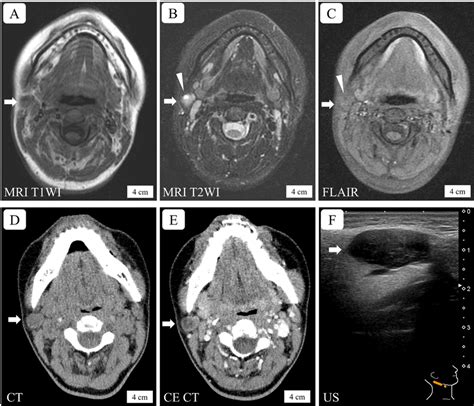 Radiological Images Of A Parotid Gland Nodule In A Young Woman With