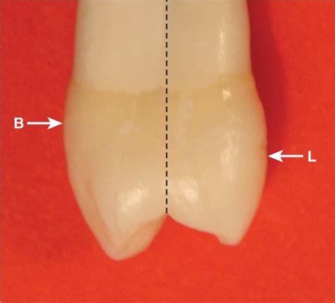 Type Traits That Distinguish Maxillary First From Second Premolars