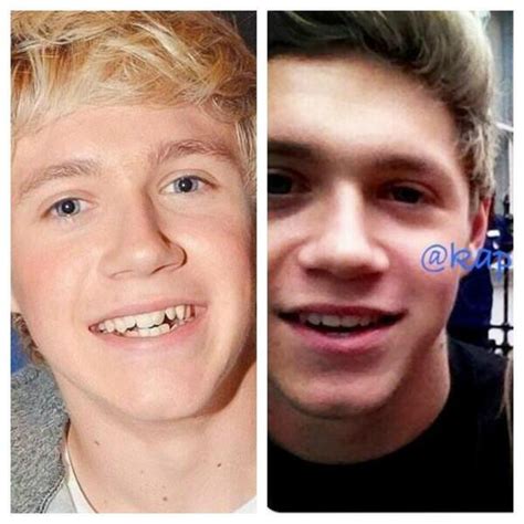 Lucy 8 Dayss On Twitter Niall Before And After Braces Hes Still Adorable He Always Will