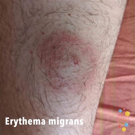 Erythema Migrans Skin Deep