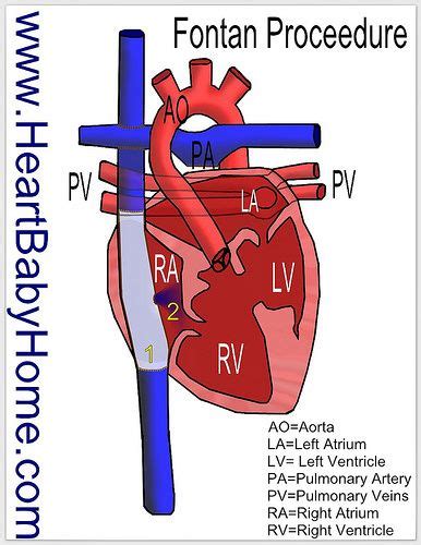 43 Fontan Procedure Ideas Congenital Heart Disease Pediatric