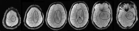 Dai is one of the most common and devastating types of traumatic brain injury and is a major cause of unconsciousness and persistent vegetative state after. Dr Balaji Anvekar FRCR: Diffuse Axonal Injury MRI