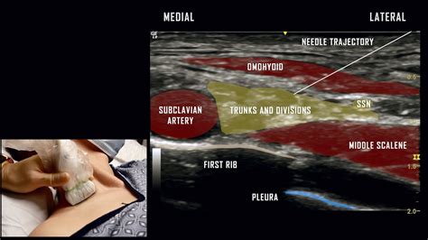 Supraclavicular Block Ultrasound Anatomy Review Youtube