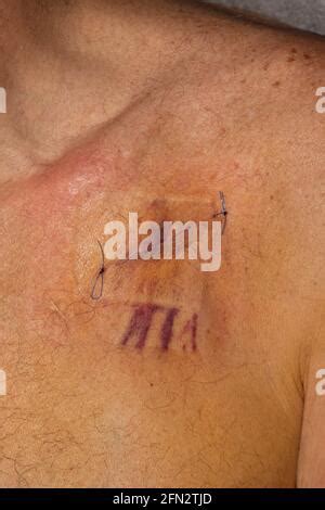 Fresh Pacemaker Scar On A Male Aged Stock Photo Alamy