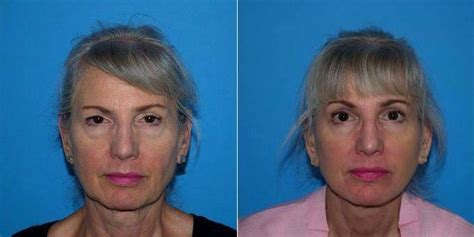 59 Year Old Woman Treated With Facelift Before And After By Dr Kyle S Choe Md Virginia Beach