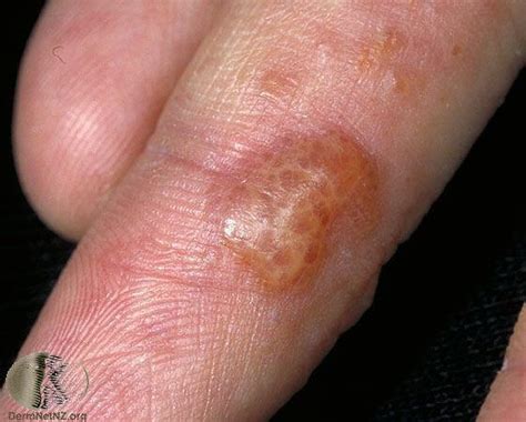 Small Fluid Filled Bumps On Hands Things You Didnt Know