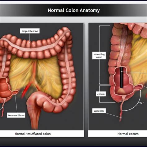 Simply put, the colon is used to provide a pause before introducing related information, while the semicolon is just a break in a sentence that is stronger than a comma but not as final as a full stop. Normal Colon Anatomy - TrialExhibits Inc.
