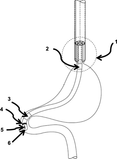 Possible Geometry Of The Modified Orogastric Catheter Adapted From