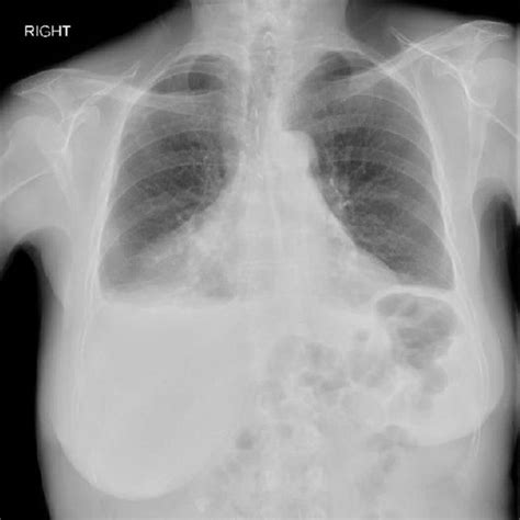Chest X Ray Revealed Bilateral Pleural Effusion Open I Images