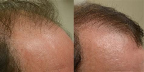 Hair Transplant Before And After Photos Men Hair Restoration Of The