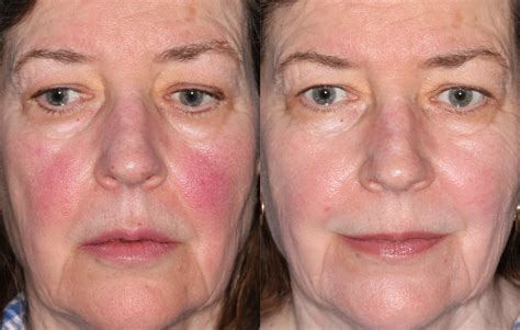 Ipl Laser For Facial Redness Cosmeticsenvogue