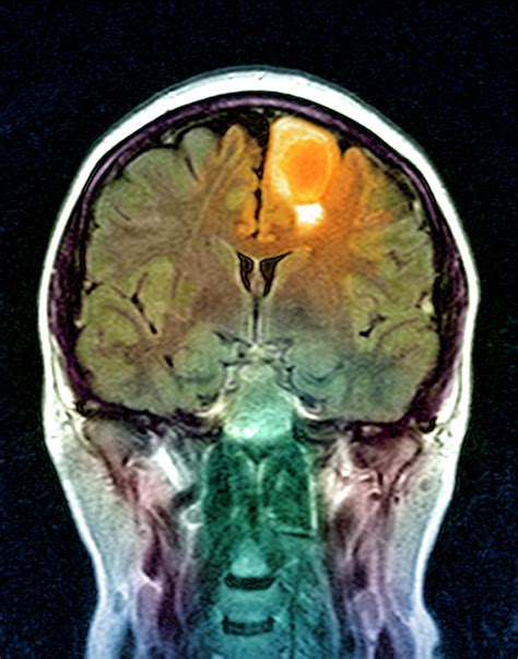 Brain Tumour Photograph By Simon Fraser Science Photo Library Pixels
