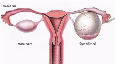 Ovarian Cyst Types Symptoms Pain Diagnosis And Treatment