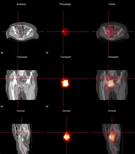 Hybrid Spect Ct An Additional Technique For Sentinel Node Detection Of