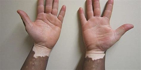 Vitiligo Associated With Lower Incidence Of Skin Cancers 2 Minute