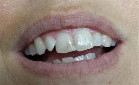 12 Fillings For Front Teeth  Teeth Walls Collection For Everyone