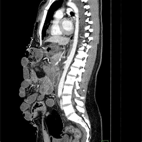 Pdf Case Report Evisceration Of Abdomen After Blunt Trauma