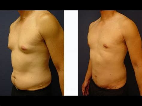 Male Abdominoplasty Before And After Photos Seattle WA Dr Brian