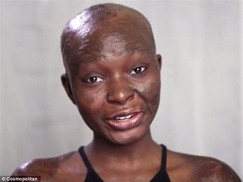 Burns Survivor Shalom Blac On How She Was Driven To Attempt Suicide By