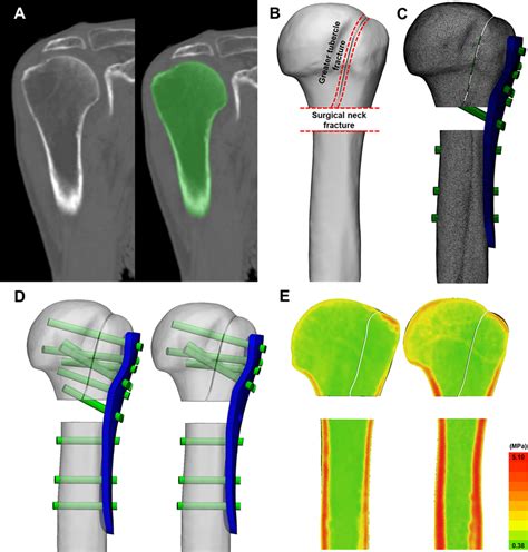 A Humerus Bone Segmentation Based On Ct Dicom Files 3d Modeling Is