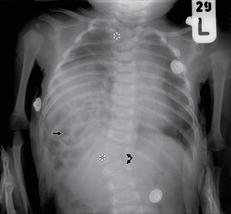 Picture Of The Month—quiz Case Radiology Jama Pediatrics Jama Network