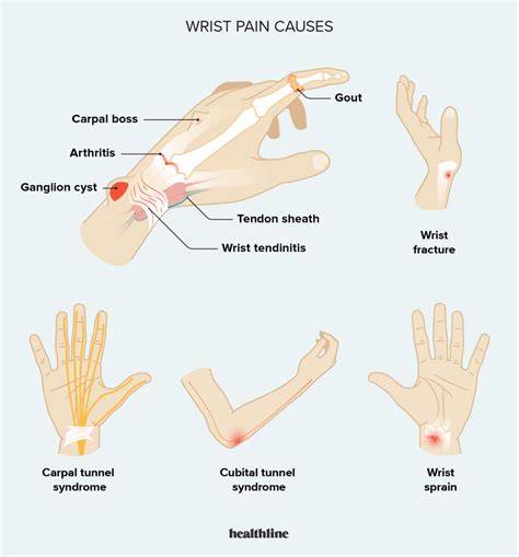 Wrist Pain Causes Symptoms Treatments And Diagnosis